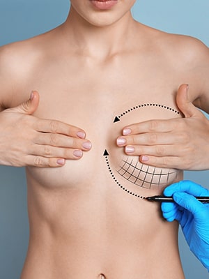 Augmentation mammaire par implants à Montpellier
